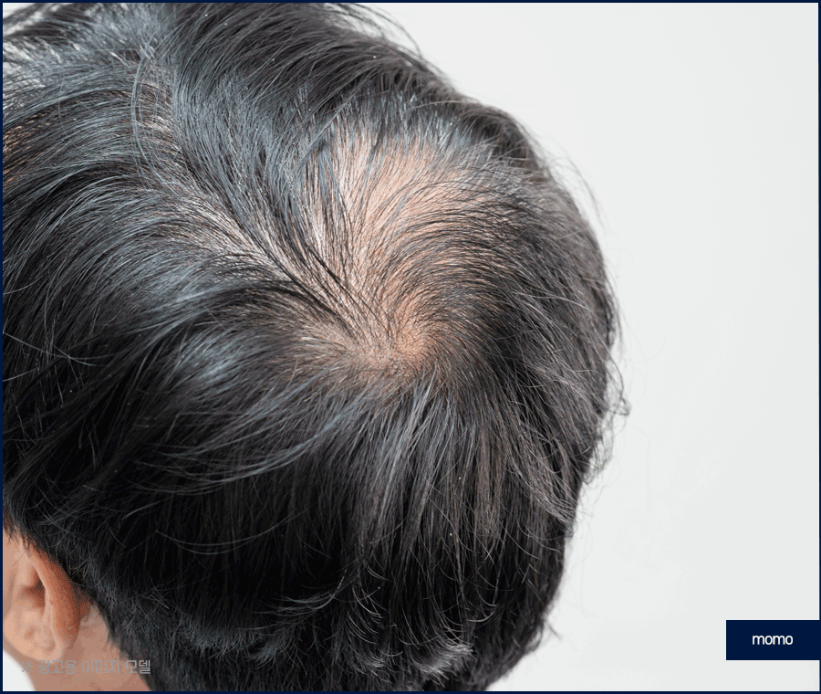 머리심기 비용 및 시술별 장단점 알아보기 관련 이미지 7