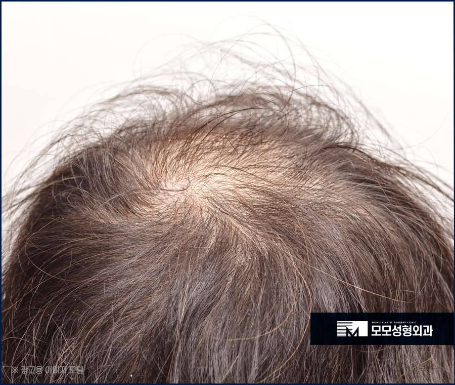 전두부탈모 원인과 보강하기 위한 방안 관련 이미지 4