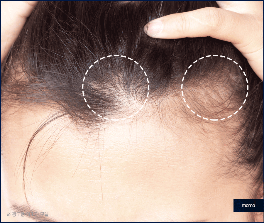 M자탈모치료 모발이식이 특별한 이유 3가지 관련 이미지 5