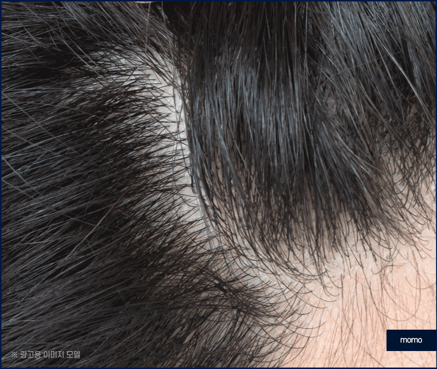 강남 탈모 병원 원인 파악부터 철저하게 시작하는 곳 관련 이미지 3