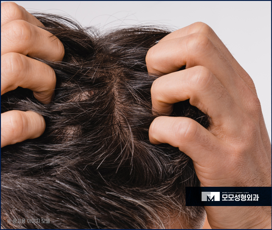 모발이식 주의사항과 꼼꼼히 숙지해야 하는 이유 관련 이미지 3