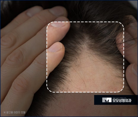 신사역 모발이식 디자인이 중요시 여겨지는 이유 관련 이미지 2