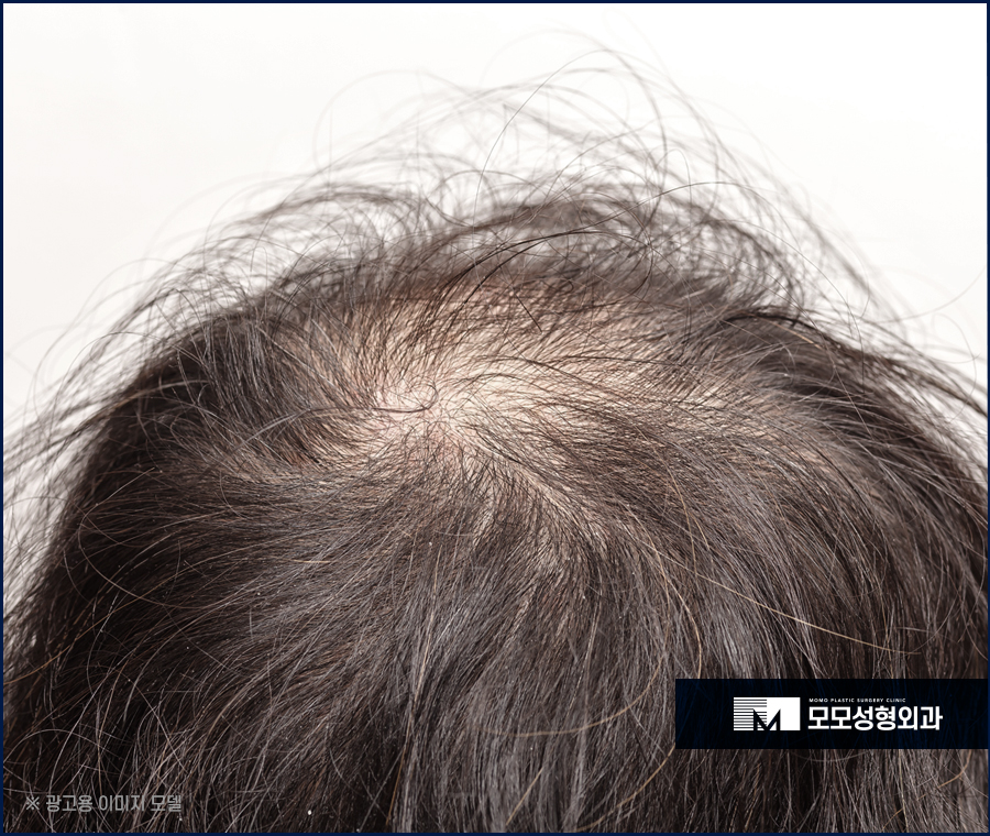 연모화 증상 원인과 방치에 대한 위험성까지 관련 이미지 5