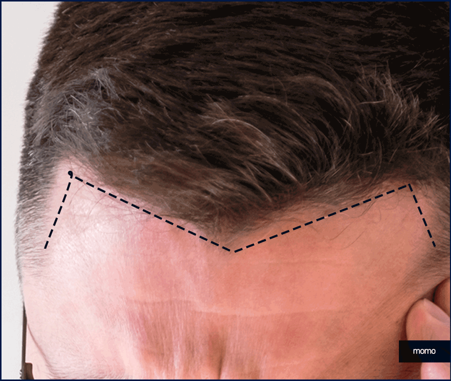 20대 모발이식 성공적인 결과를 위한 필수 조건 관련 이미지 9