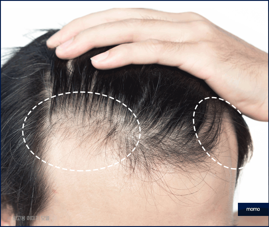 압구정모발이식 원하던 모습을 찾는 포인트 관련 이미지 11