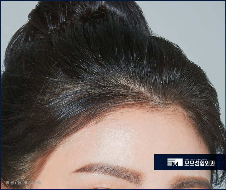 여성헤어라인모발이식 채워 주기 위한 방법은 관련 이미지 8