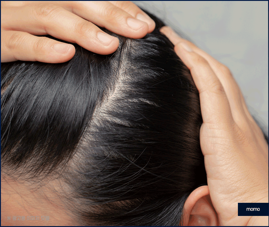 중학생탈모 발생 원인 및 보완하는 방법은? 관련 이미지 8