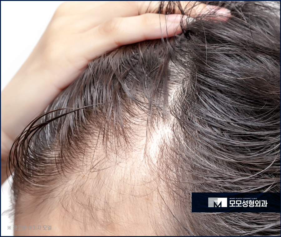 남자 앞머리 탈모 M자 라인 깊어짐이 보인다면 관련 이미지 4