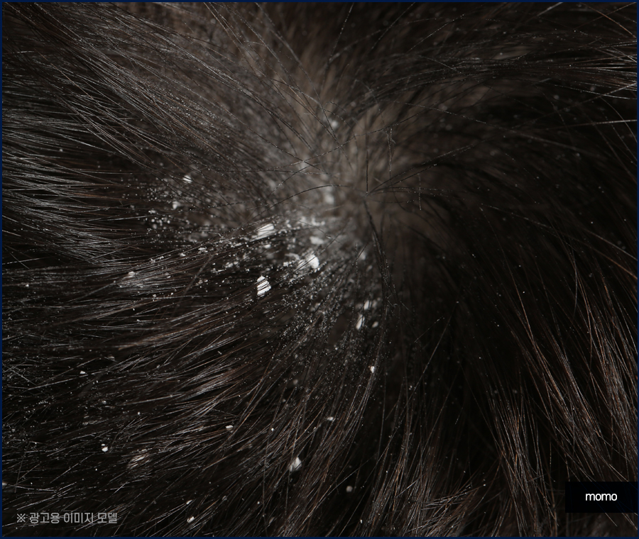 머리비듬없애는법 효과적인 비결에 대해 관련 이미지 2