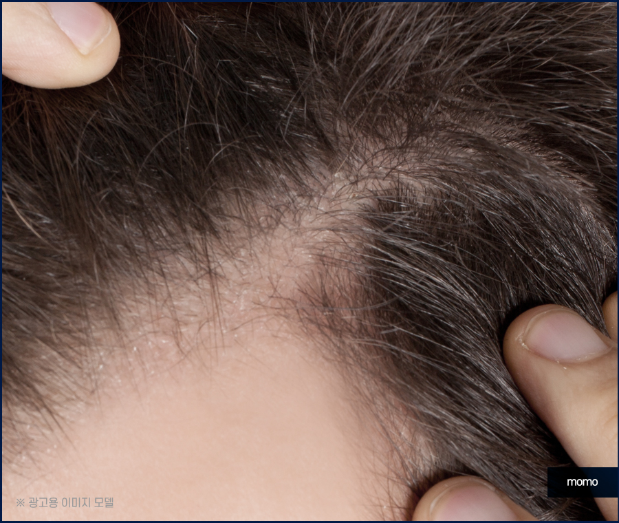 모발이식 후 운동 언제부터 하는게 좋을까요 관련 이미지 6