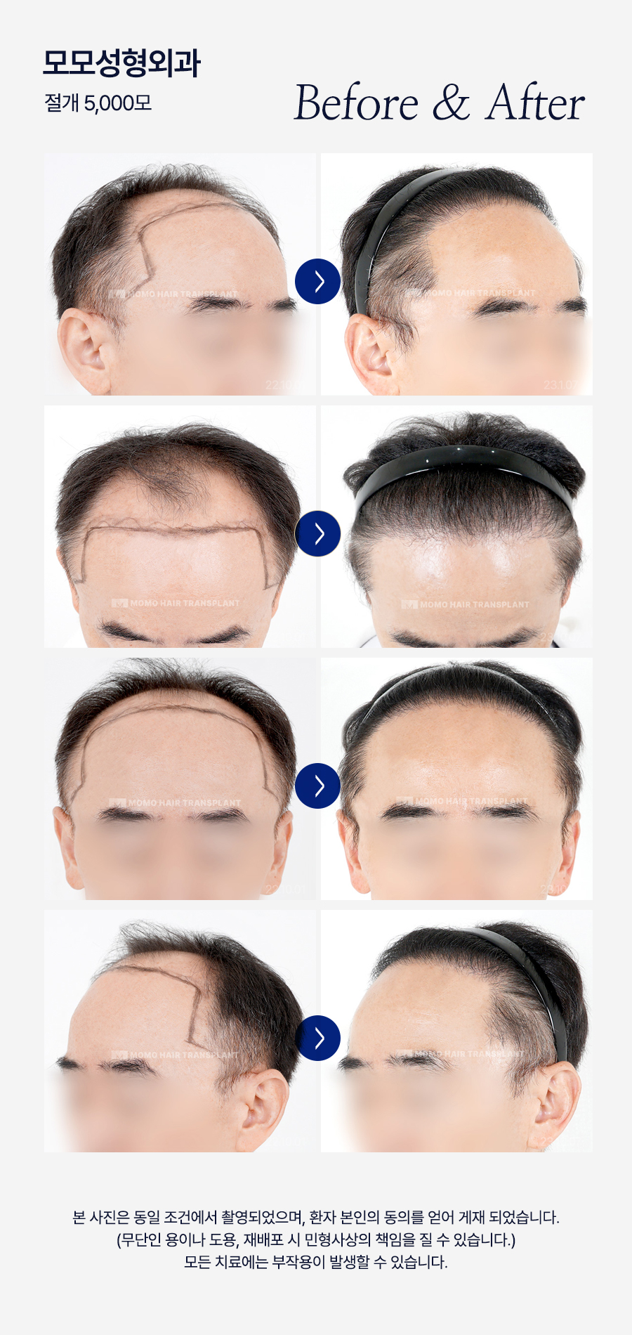 모발이식 생착기간 섬세한 관리가 필요한 이유 관련 이미지 16