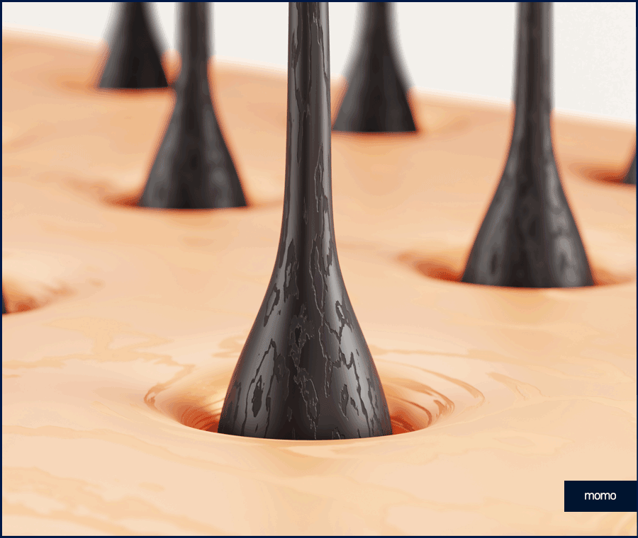 M자탈모치료 모발이식이 특별한 이유 3가지 관련 이미지 3