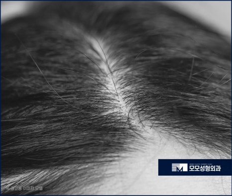 여자 옆머리 탈모 이유와 극복하고 채워가려면 관련 이미지 5