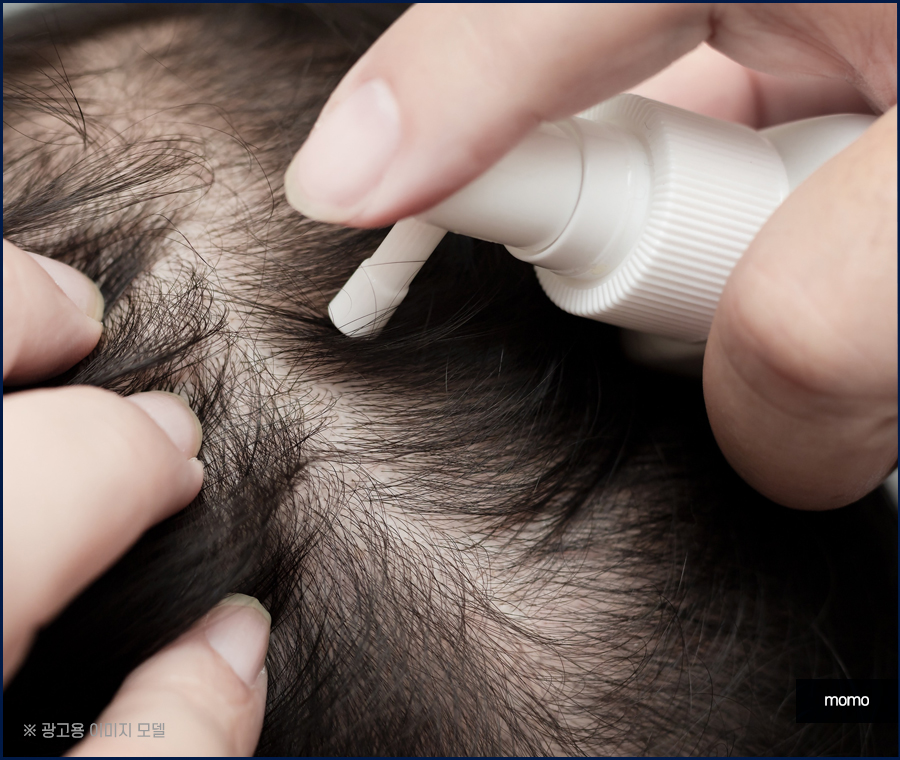 여자 정수리 탈모 모발이식 꼼꼼히 채우는 관련 이미지 7