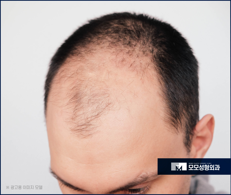 절개모발이식병원 생착률까지 생각해서 관련 이미지 2