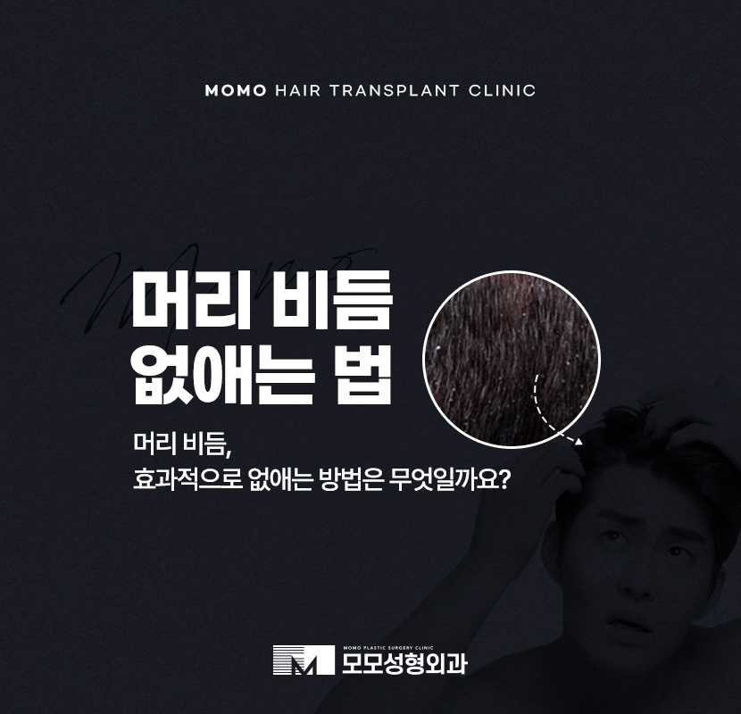 머리비듬없애는법 효과적인 비결에 대해 관련 이미지 1