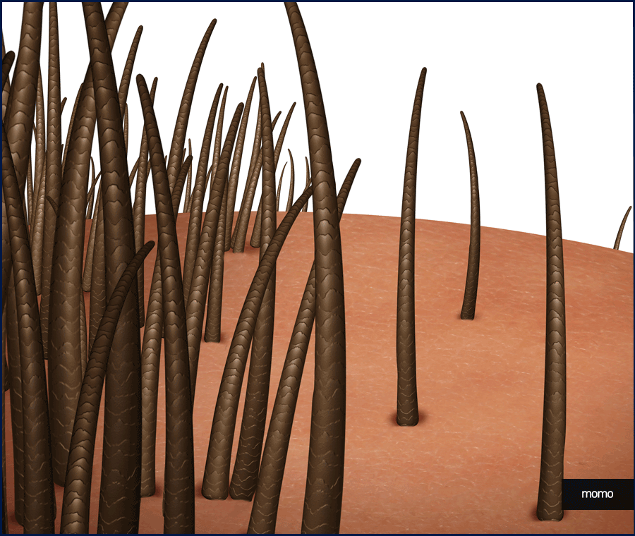 모발이식 금액 개인마다 차이가 나는 이유 관련 이미지 2