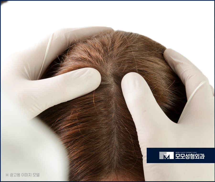 여성 옆머리 탈모 증상이 보여질 경우 해결 방법은 관련 이미지 3