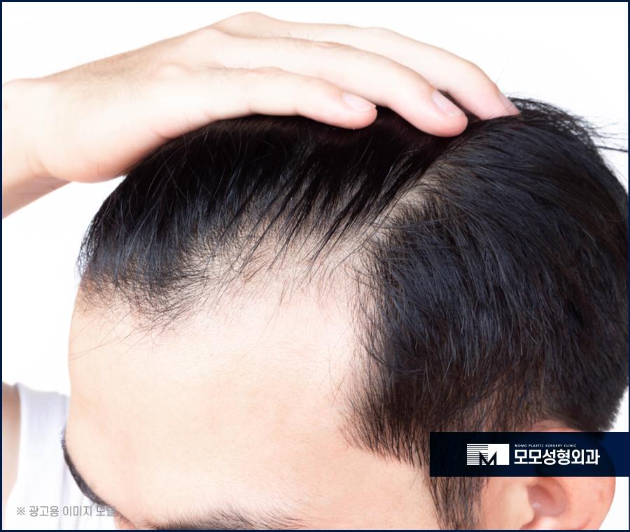 엠자이마모발이식 자연스럽게 채워지는 관련 이미지 7