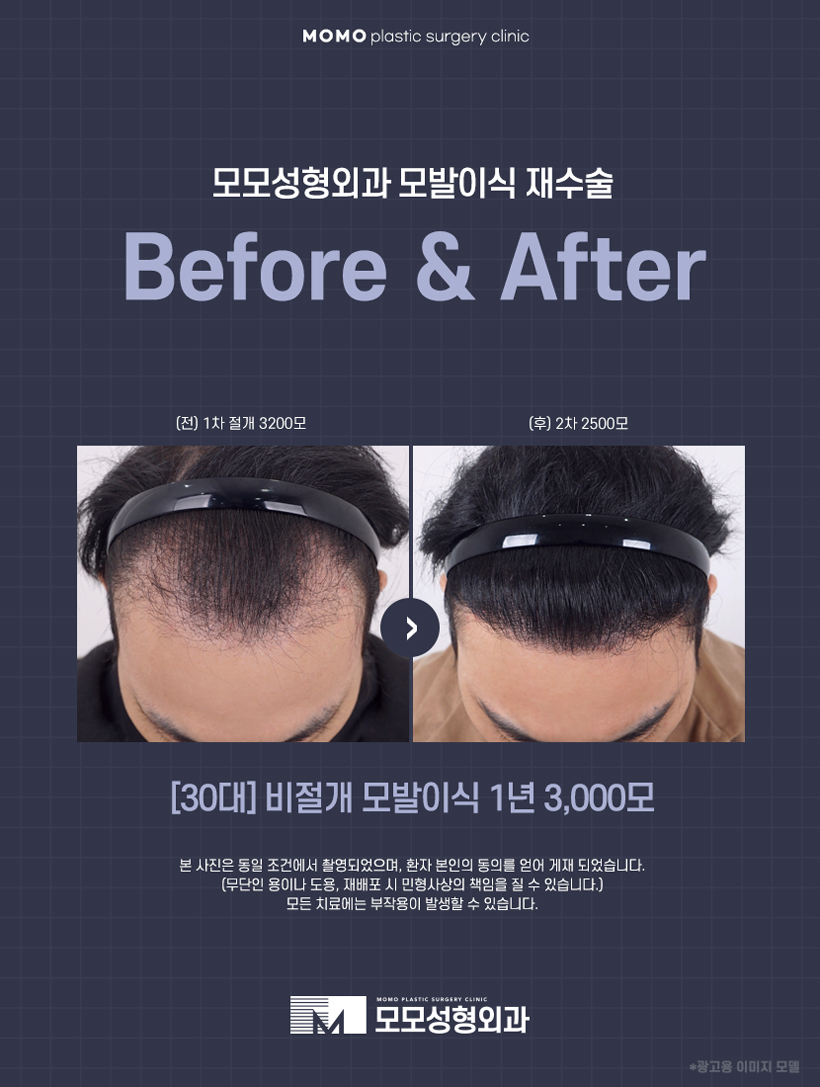 M자이마모발이식 빈 곳을 섬세하게 보완하며 관련 이미지 4