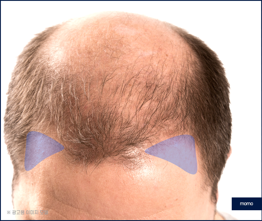 m자탈모초기 빠른 대처를 이뤄낸다면 관련 이미지 6