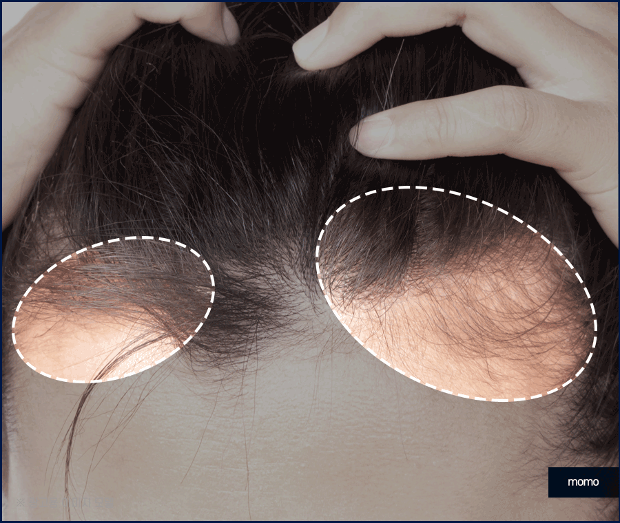 남자헤어라인모발이식 디자인의 중요성 관련 이미지 7