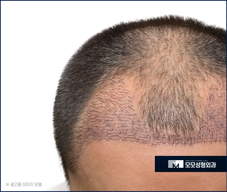 모발이식 붓기 지속 시간과 완화를 돕는 방안은 관련 이미지 3