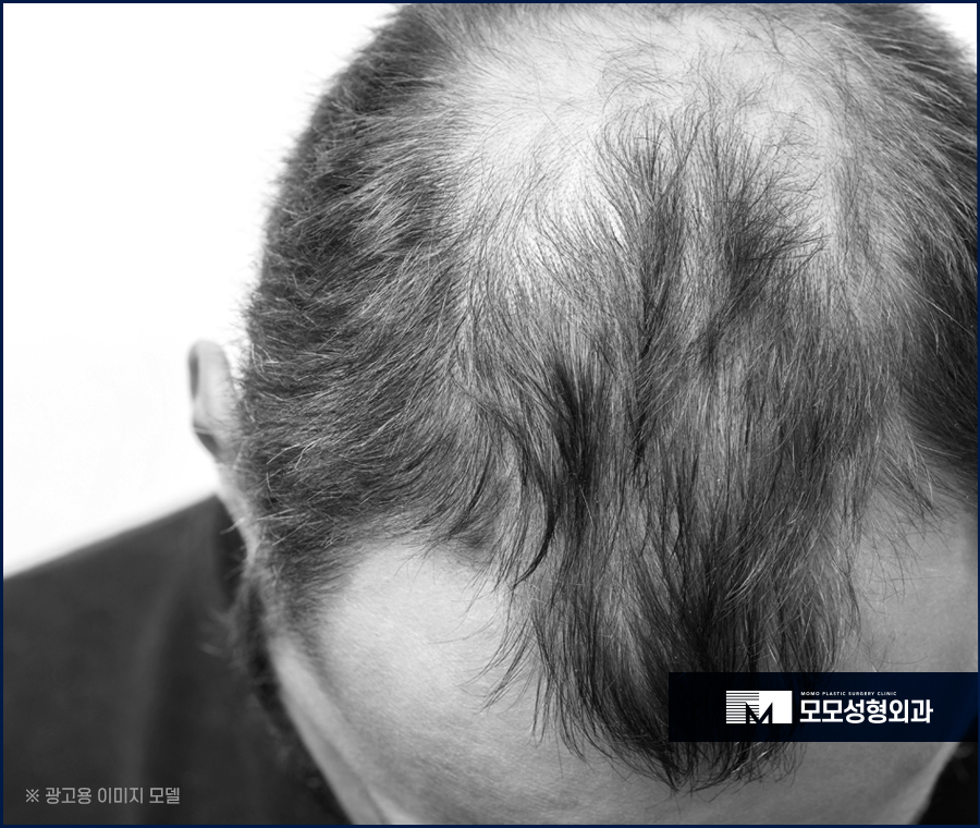 엠자탈모모발이식 안정적인 과정으로 나아가며 관련 이미지 3