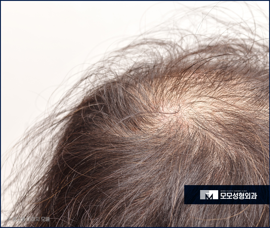 압구정모발이식 결과를 우수하게 만드려면 관련 이미지 2