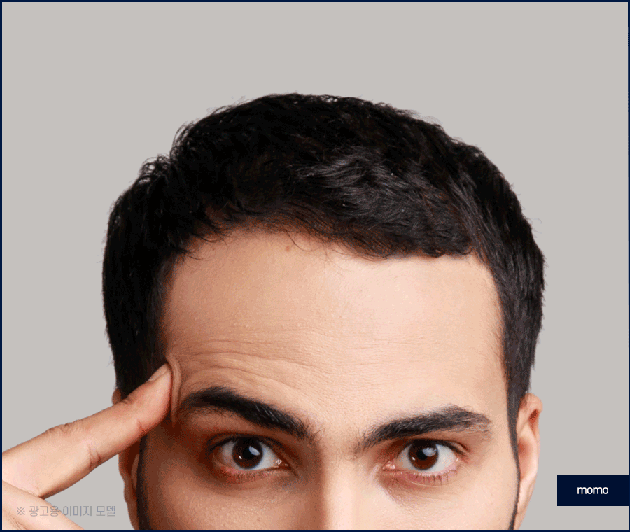 이마 축소술 비용 및 모발이식이 선호되는 이유 관련 이미지 4