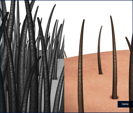 헤어라인 교정 비용 및 방법 디자인의 중요성 관련 이미지 2