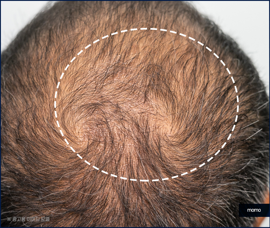 두피가 아파요 증상 원인과 해결하는 방안은 관련 이미지 7