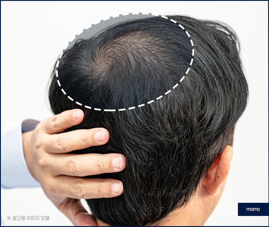 남자 가르마 탈모 진짜 내 머리처럼 채우려면 관련 이미지 7