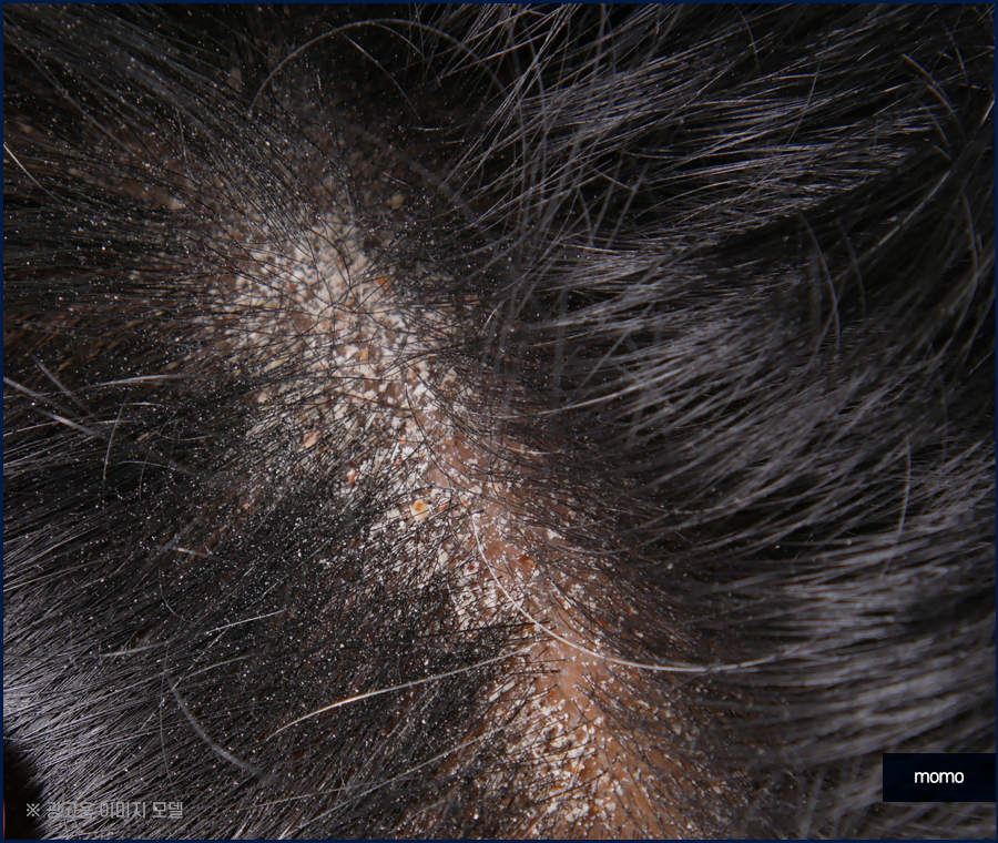 머리비듬없애는법 효과적인 비결에 대해 관련 이미지 6