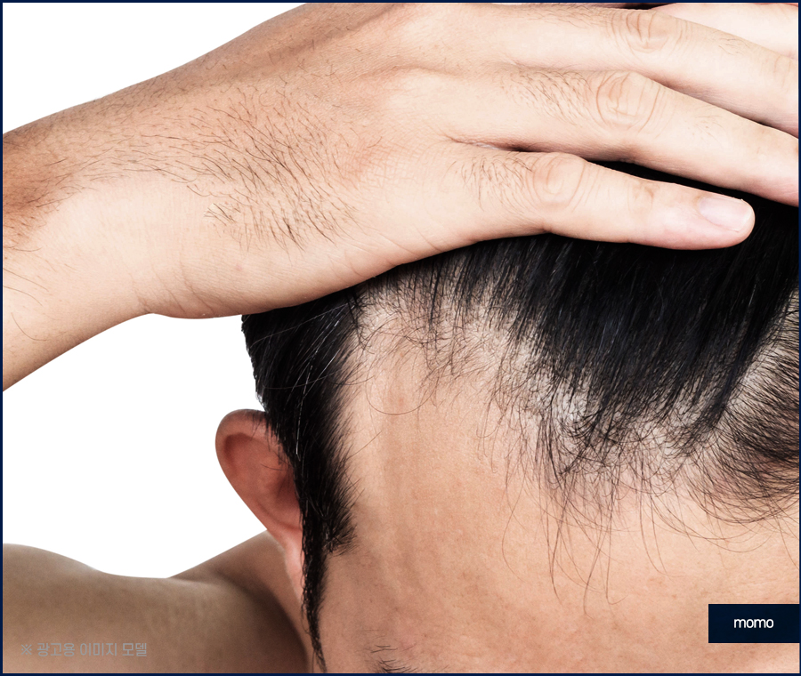 앞머리 모발이식 가격 차이부터 확인하며 관련 이미지 6