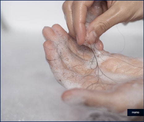 20대 원형탈모 효과적인 개선 방법은 관련 이미지 2