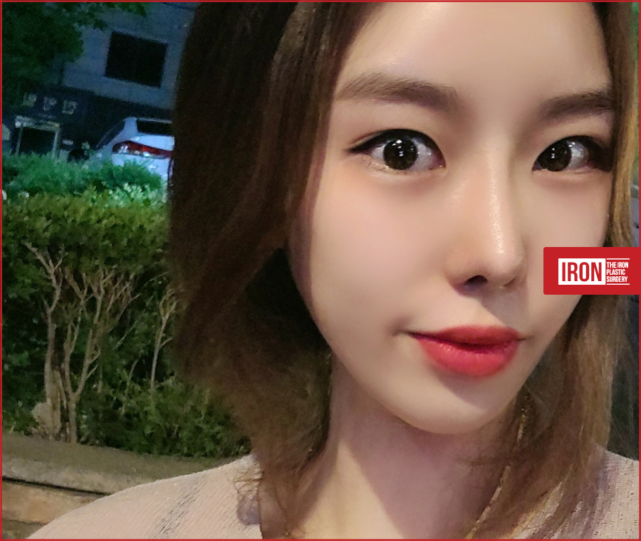 신사동 눈성형 똘망똘망한 눈매로 거듭나기 위해 관련 이미지 3