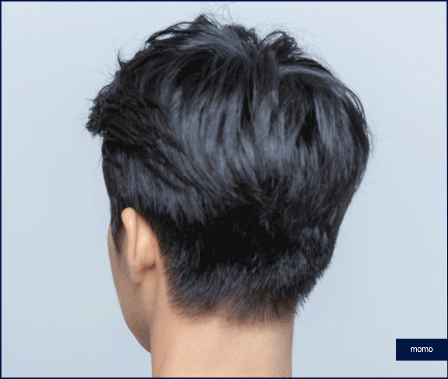 압구정 모발이식 세심한 사전 진단부터 시작하는 곳 관련 이미지 2