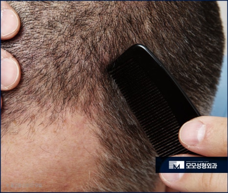 남자머리심기 신속한 일상 회복을 위한 방법 (ft. 비절개모발이식) 관련 이미지 3