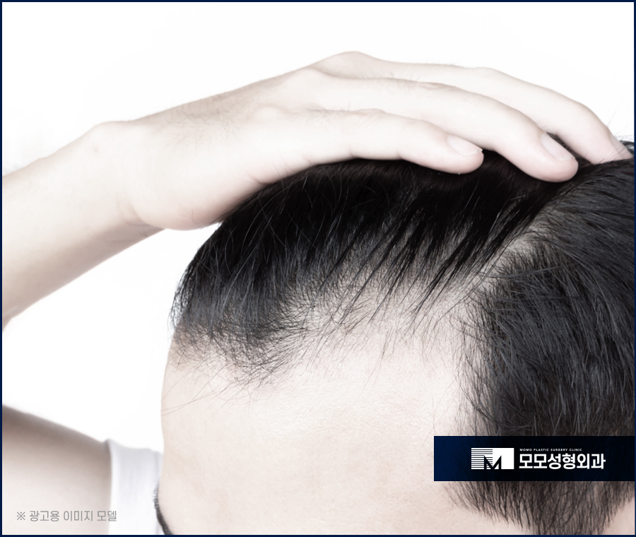 M자모발이식가격 충분한 보강을 원한다면 관련 이미지 2