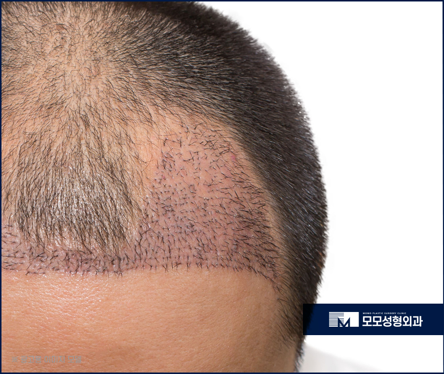 모발이식사후관리 우수한 수준의 예후를 만드는 방법 관련 이미지 7