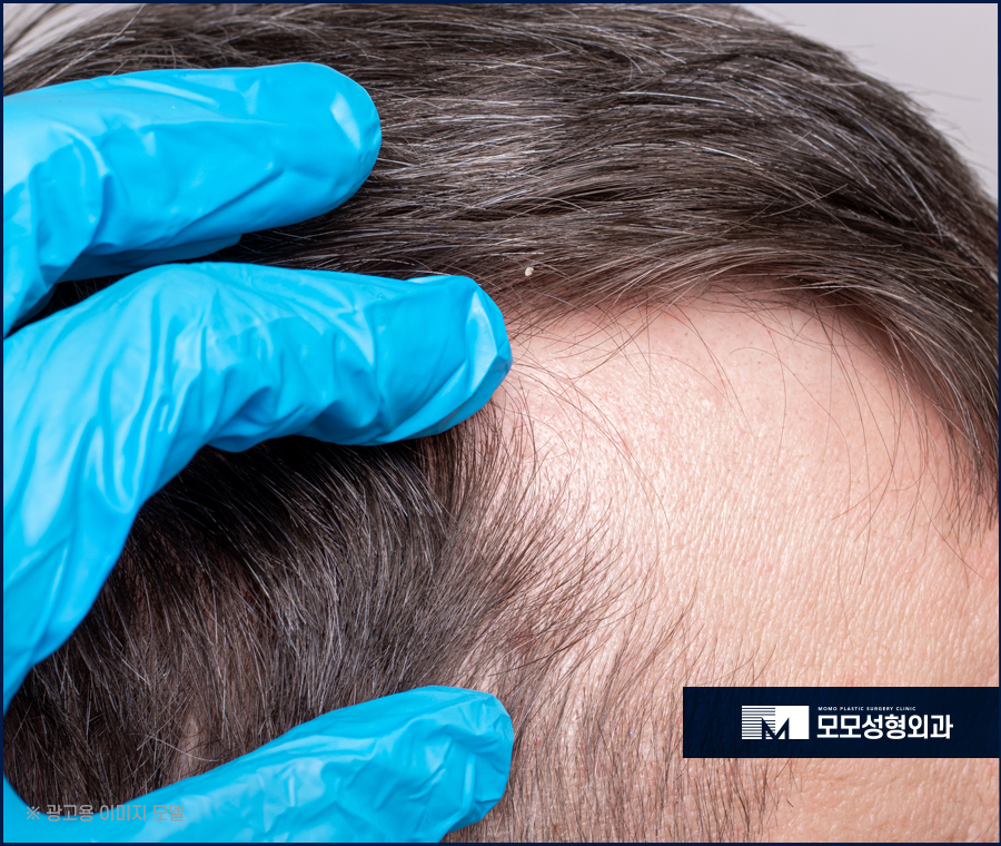m자탈모초기증상 면밀하게 관찰해야 하는 이유 관련 이미지 3