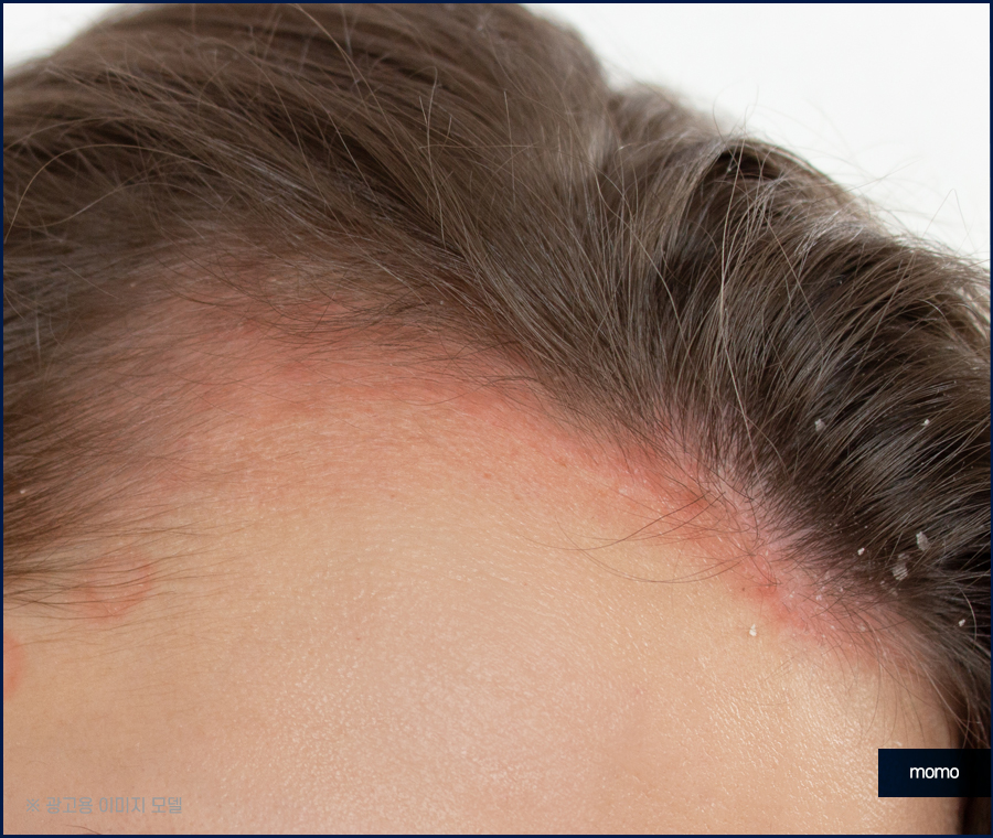 두피 누르면 통증이 느껴질 경우 위험한 이유 관련 이미지 4