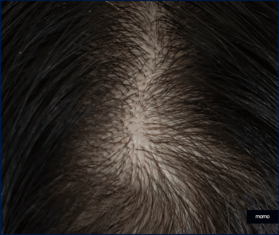 탈모약 복용시간의 중요성 및 주의사항 정리 관련 이미지 2