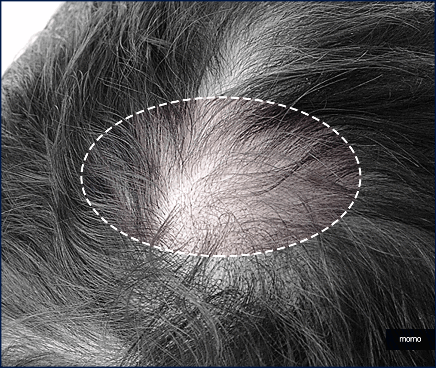 모발이식 3000모 비용 차이나는 이유 및 방법 관련 이미지 8