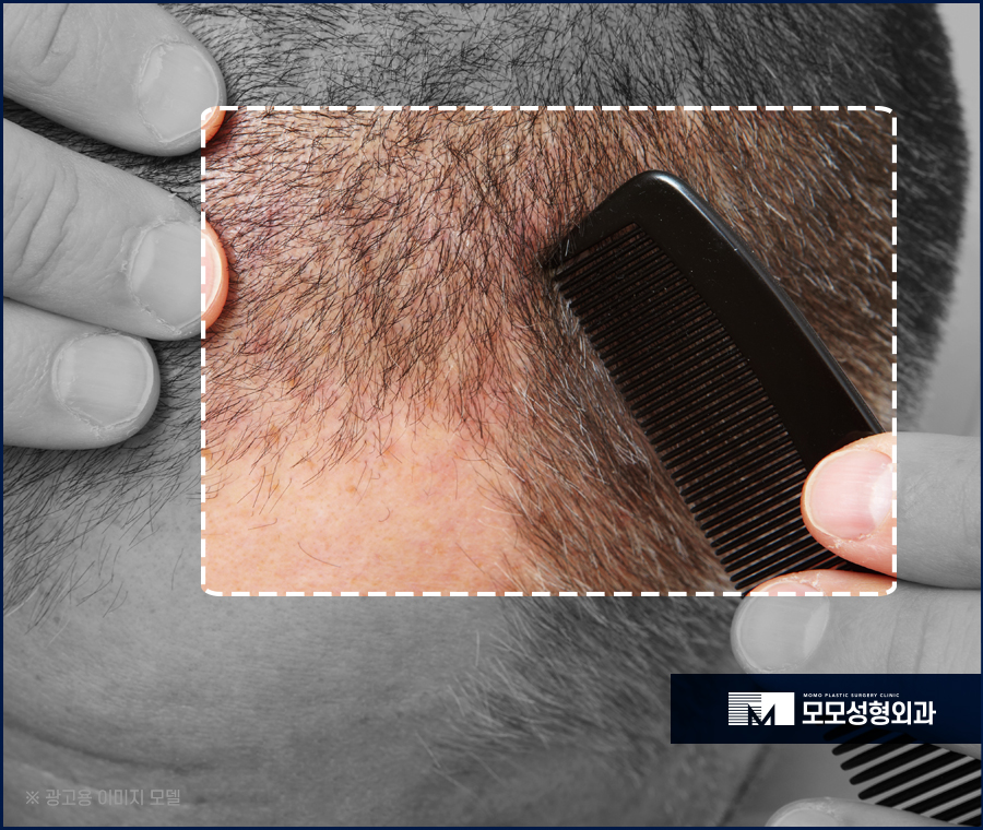 모발 얇아짐 이유와 두께를 복구하는 방법 관련 이미지 7