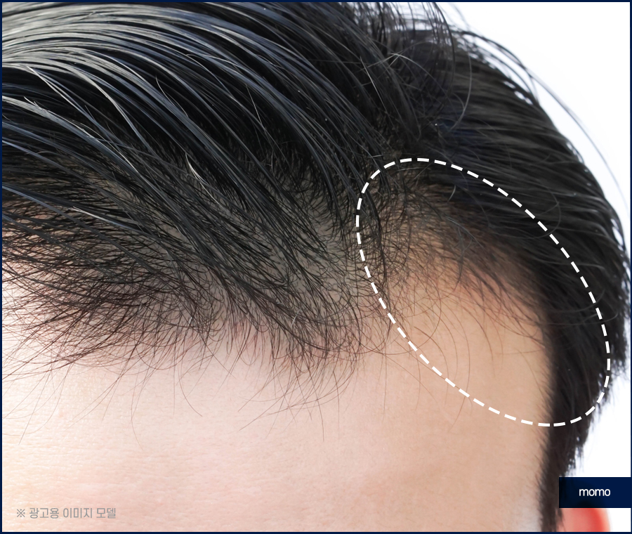 모발이식잘하는곳 찾는 결정적인 기준 관련 이미지 7