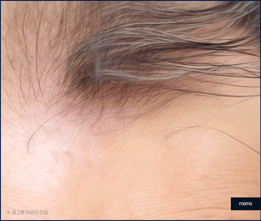 강남 탈모 병원 원인 파악부터 철저하게 시작하는 곳 관련 이미지 12