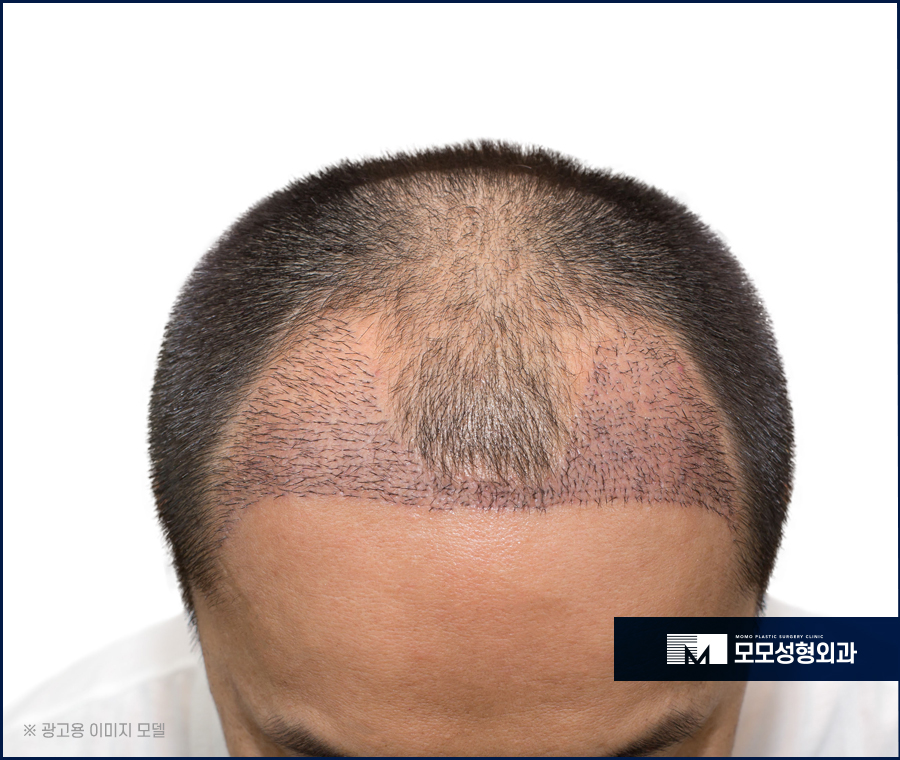 모발이식절개비절개 두 가지의 차이는 관련 이미지 10