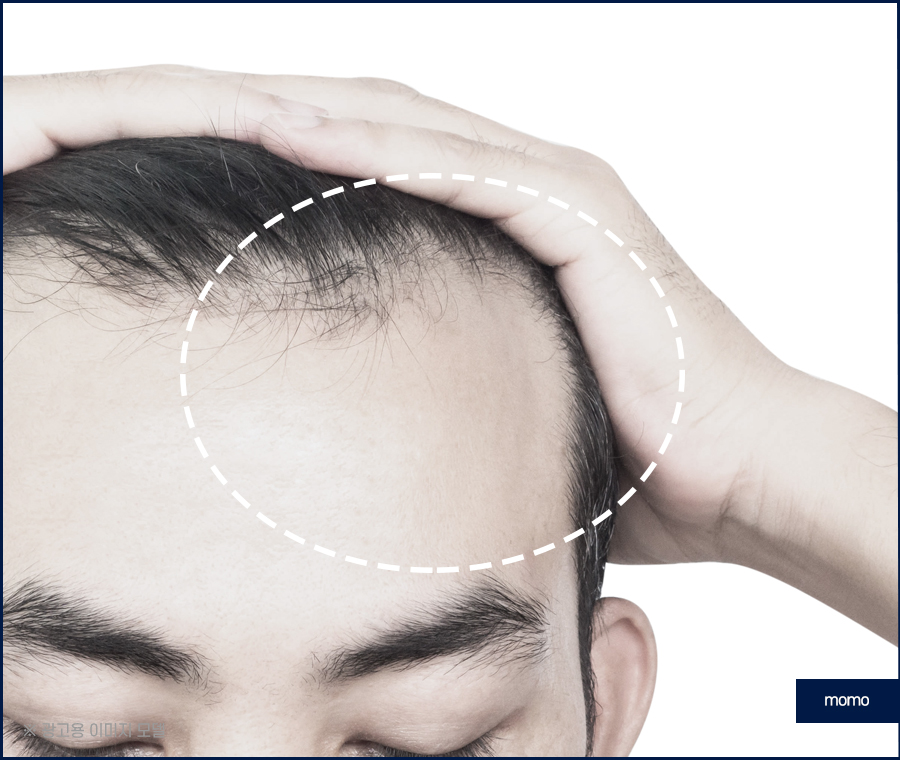 넓은이마모발이식 헤어 라인을 깔끔히 정리하는 관련 이미지 6